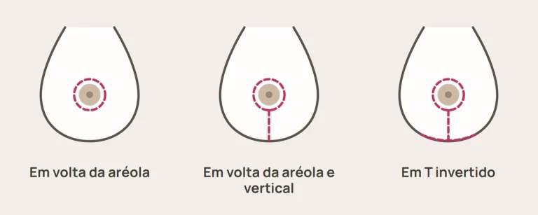 Mastopexia: desenho das cicatrizes em volta da aréola, em volta da aréola e vertical, e em T invertido